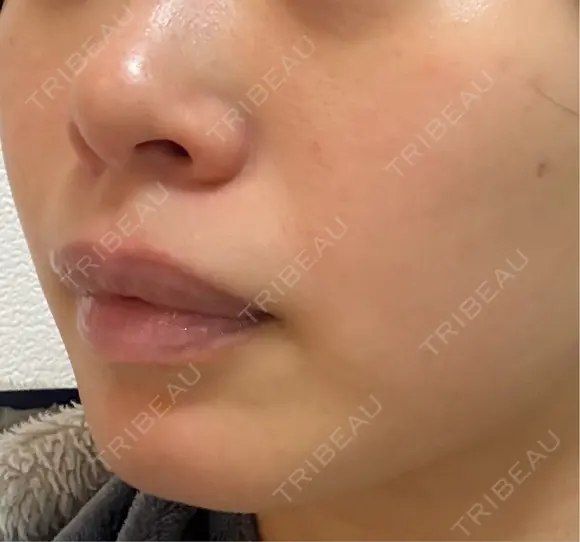 光治療（フォトフェイシャルなど） 品川美容外科 渋谷院（※品川スキンクリニック提携） DAY 9 メイン用