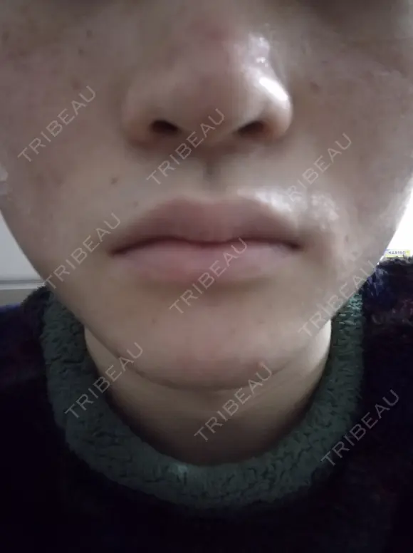 イオン導入 / ピーリング（ハリ・ツヤ） / ルメッカ ルラ美容クリニック 札幌本院 AFTER メイン用