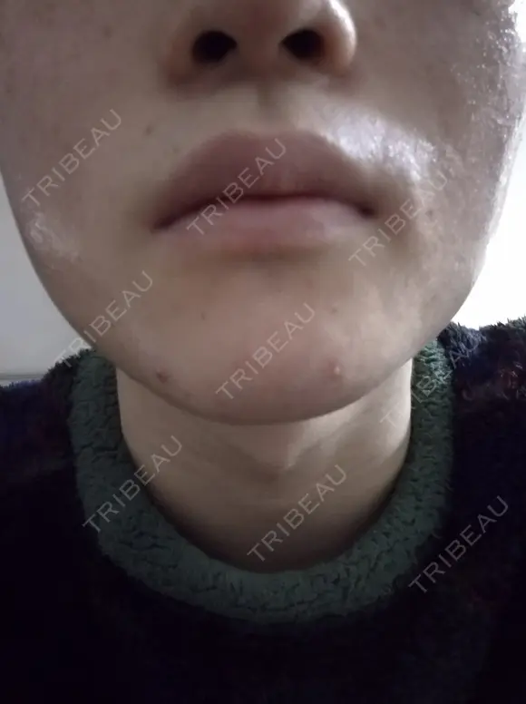 イオン導入 / ピーリング（ハリ・ツヤ） / ルメッカ ルラ美容クリニック 札幌本院 DAY 0 メイン用