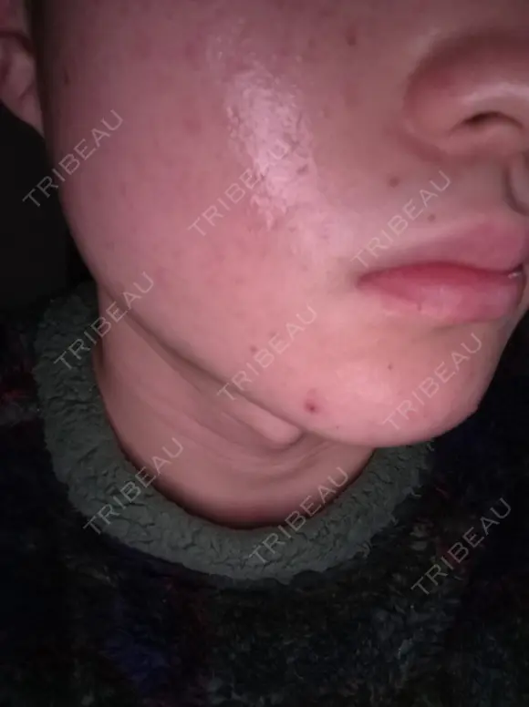 イオン導入 / ピーリング（ハリ・ツヤ） / ルメッカ ルラ美容クリニック 札幌本院 DAY 0 メイン用