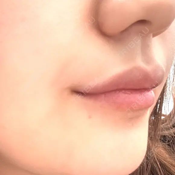 ヒアルロン酸注入（唇） / ボトックス（口角） ルラ美容クリニック 名古屋本院 DAY 2 メイン用
