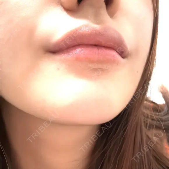 ヒアルロン酸注入（唇） / ボトックス（口角） ルラ美容クリニック 名古屋本院 DAY 2 メイン用
