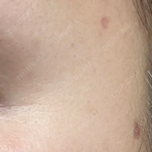 ほくろ・いぼ除去レーザー（肌） Fellez Clinic【フェルズクリニック】 DAY 32 メイン用