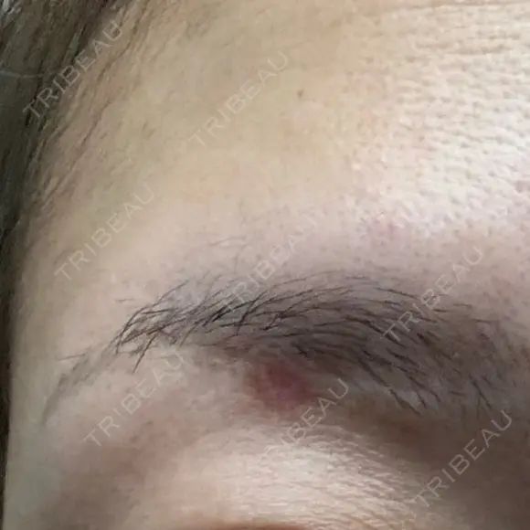 ほくろ・いぼ除去レーザー（肌） Fellez Clinic【フェルズクリニック】 DAY 32 メイン用