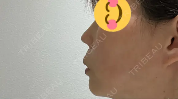 隆鼻術 / 鼻尖形成（切開） / 鼻中隔延長（切開） / 軟骨移植 / プロテーゼ除去 / 鼻修正 東京美容外科 名古屋院 AFTER メイン用