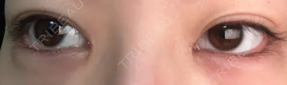 ヒアルロン酸注入（涙袋） 吉祥寺アイビークリニック DAY 7 メイン用