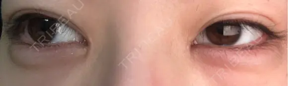 ヒアルロン酸注入（涙袋） 吉祥寺アイビークリニック DAY 8 メイン用