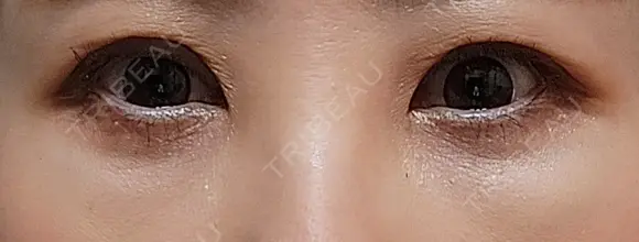 二重切開 / 眼瞼下垂（切開） / 下まぶたの脂肪取り EMMA CLINIC（エマクリニック） DAY 18 メイン用
