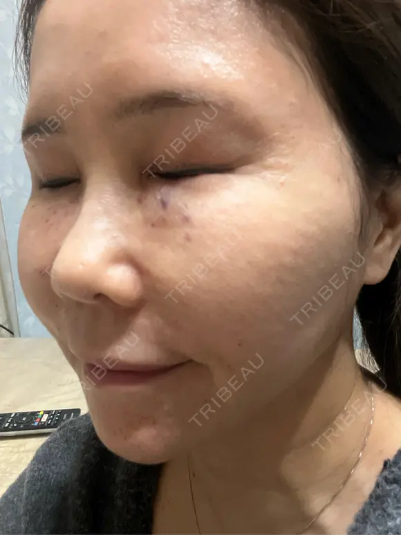 水光注射（ハリ・美肌） / ハイフ（首） しんゆり美容健康クリニック DAY 0 メイン用