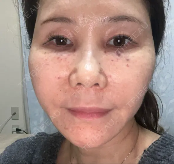 水光注射（ハリ・美肌） / ハイフ（首） しんゆり美容健康クリニック DAY 0 メイン用