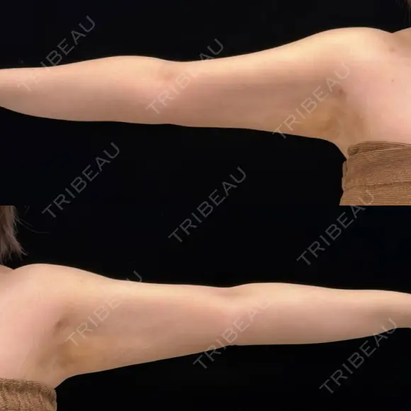 脂肪吸引（二の腕） EMMA CLINIC（エマクリニック） AFTER メイン用