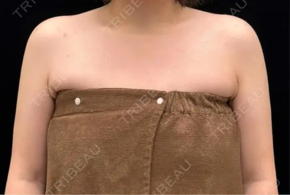 脂肪吸引（二の腕） EMMA CLINIC（エマクリニック） DAY 183 メイン用