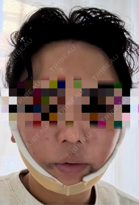 糸リフト / 脂肪吸引（顔） / 脂肪注入（額） / ボトックス（エラ・小顔） / ボトックス（口角） / 脂肪注入（輪郭） / その他（輪郭） 4Dクリニック DAY 7 メイン用