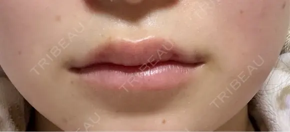 小鼻縮小（非切開） / ヒアルロン酸注入（唇） 千葉美容外科アイビークリニック AFTER メイン用