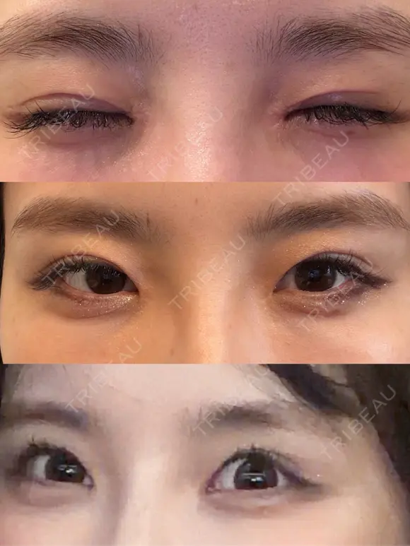 二重切開 / 眼瞼下垂（切開） / スレッドノーズ / ヒアルロン酸注入（鼻翼基部） オーキッド美容クリニック東京御徒町 DAY 459 メイン用