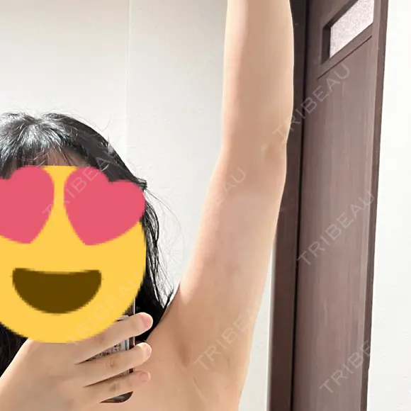 インディバ（二の腕） 渋谷美容外科クリニック 横浜院 DAY 2 メイン用
