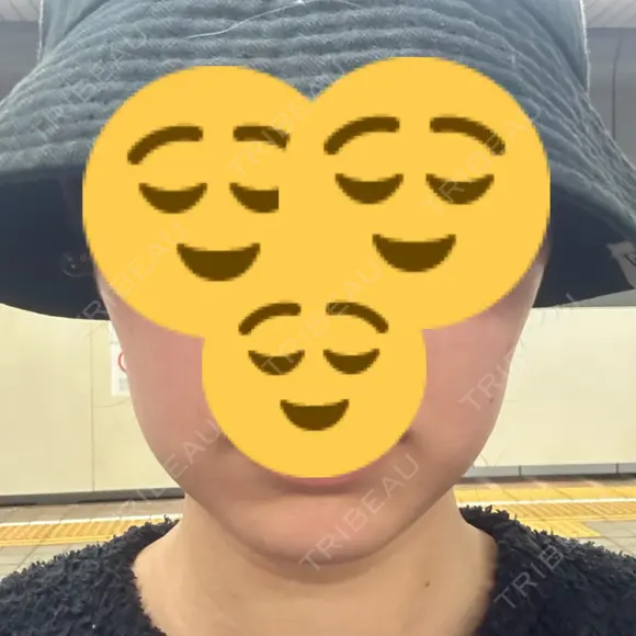 オンダリフト ルラ美容クリニック 名古屋本院 DAY 0 メイン用