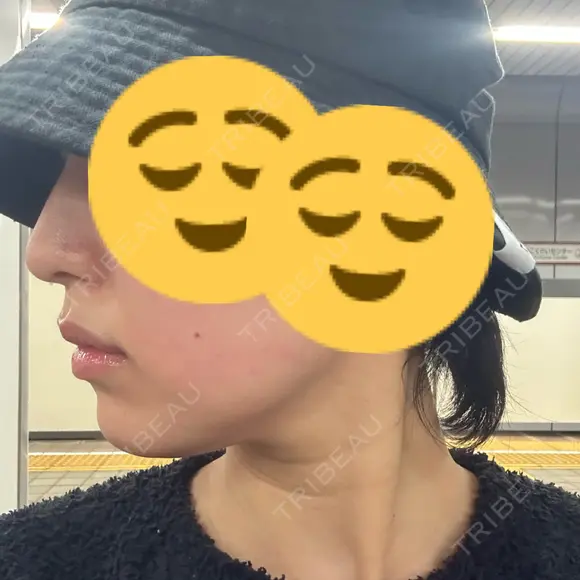 オンダリフト ルラ美容クリニック 名古屋本院 DAY 0 メイン用