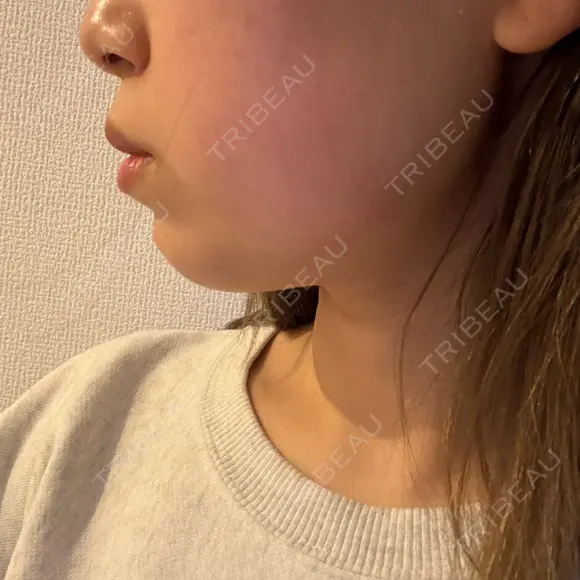 ボトックス（エラ・小顔） / インモード Moon Beauty Clinic DAY 0 メイン用