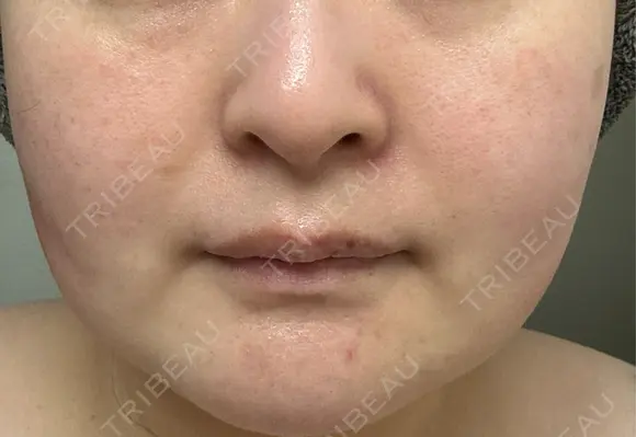 その他（肌） / シミ取りレーザー / ルメッカ ルラ美容クリニック 郡山院 DAY 28 メイン用