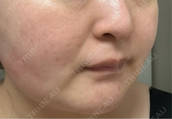 その他（肌） / シミ取りレーザー / ルメッカ ルラ美容クリニック 郡山院 DAY 28 メイン用