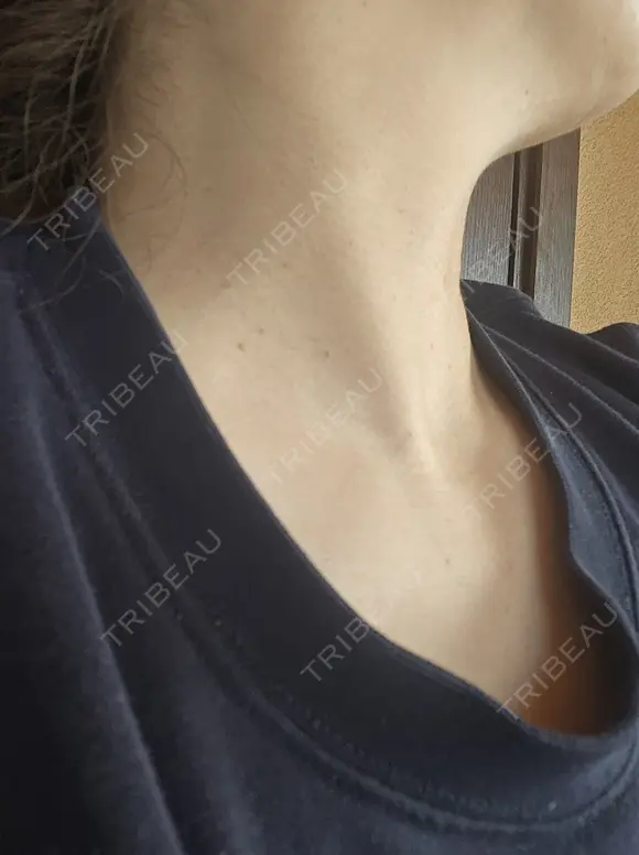 ハイフ（首） アクティブエイジクリニック DAY 2 メイン用