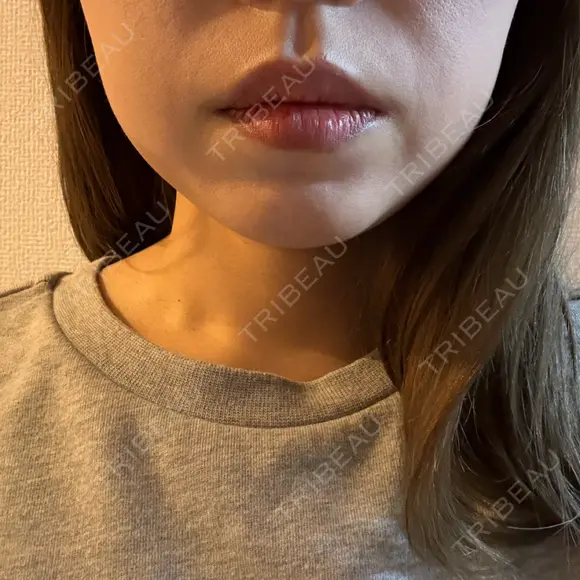 ボトックス（エラ・小顔） / インモード Moon Beauty Clinic DAY 1 メイン用