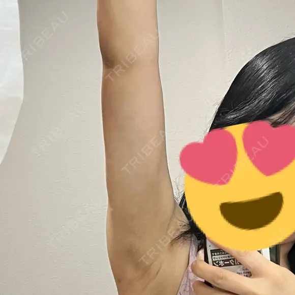 インディバ（二の腕） 渋谷美容外科クリニック 横浜院 DAY 3 メイン用