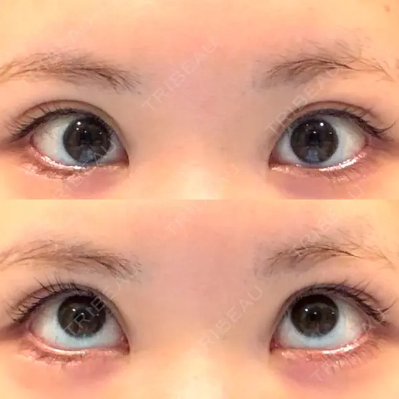 タレ目形成・グラマラスライン（切開） 形成外科と美容外科のクリニック池袋 DAY 26 メイン用