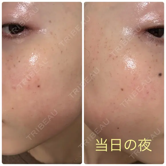 ピーリング（ニキビ・毛穴） / イオン導入 / ルメッカ ルラ美容クリニック 札幌本院 DAY 0 メイン用