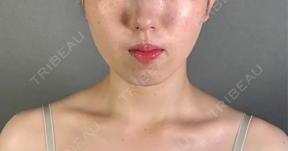 糸リフト / バッカルファット除去 / 脂肪吸引（顔） / ジョールファット除去 / ボトックス（エラ・小顔） アリエル美容クリニック 郡山院 AFTER メイン用