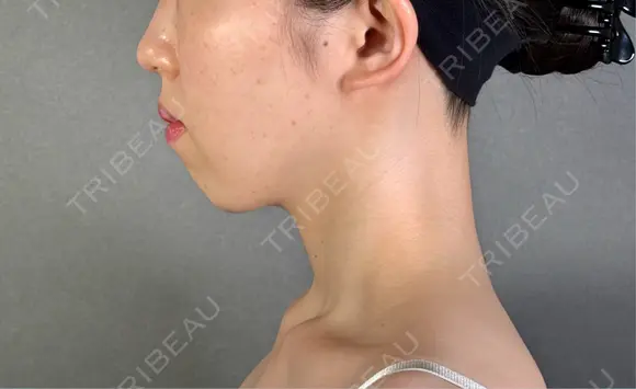 糸リフト / バッカルファット除去 / 脂肪吸引（顔） / ジョールファット除去 / ボトックス（エラ・小顔） アリエル美容クリニック 郡山院 DAY 185 メイン用