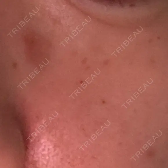 ほくろ・いぼ除去レーザー（肌） 心斎橋KT美容クリニック DAY 1 メイン用