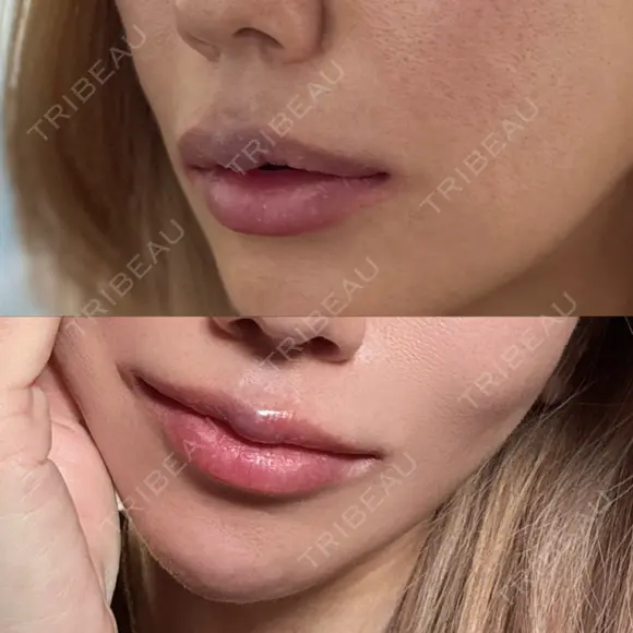 ヒアルロン酸注入（唇） HAAB BEAUTY CLINIC 名古屋院 DAY 1 メイン用