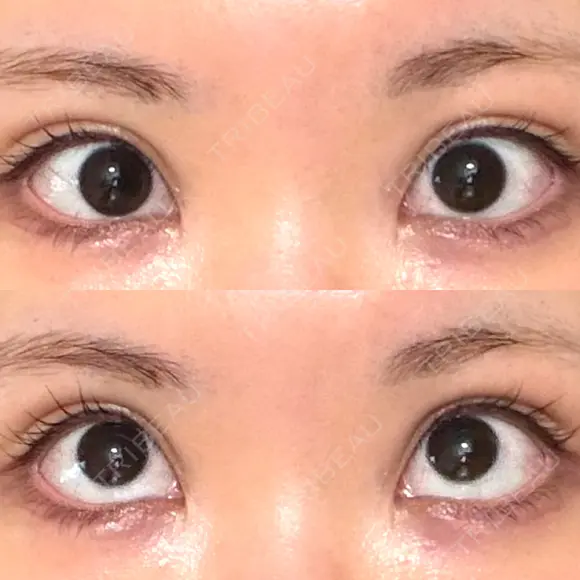 タレ目形成・グラマラスライン（切開） 形成外科と美容外科のクリニック池袋 DAY 27 メイン用