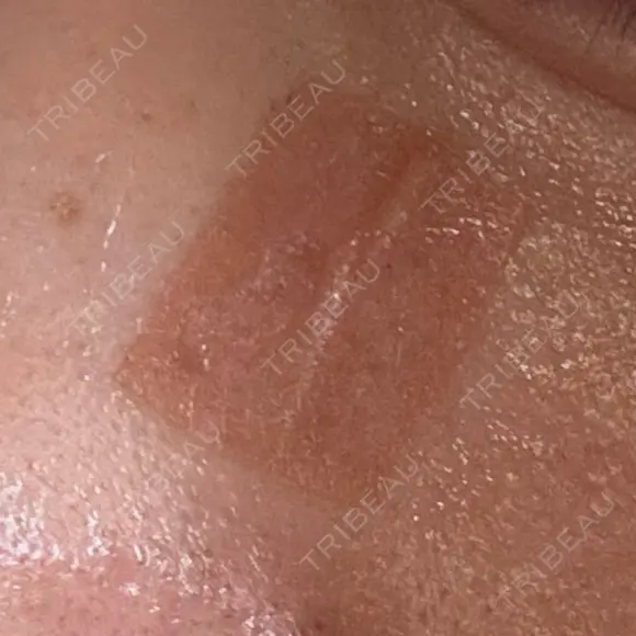 ほくろ・いぼ除去レーザー（肌） 心斎橋KT美容クリニック DAY 2 メイン用