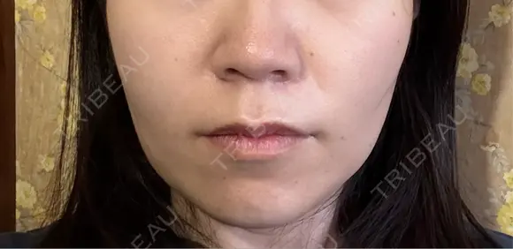 医療脱毛（顔） ダビデクリニック渋谷 AFTER メイン用