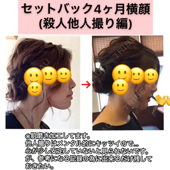 あごプロテーゼ / その他（輪郭） / セットバック / その他（審美歯科/矯正歯科） 大塚美容形成外科・歯科 大塚本院 DAY 126 メイン用