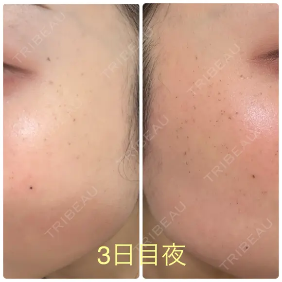 ピーリング（ニキビ・毛穴） / イオン導入 / ルメッカ ルラ美容クリニック 札幌本院 DAY 3 メイン用