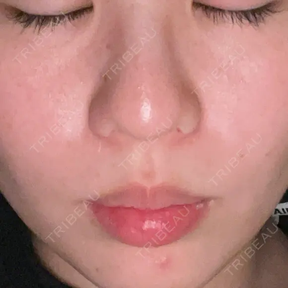 ピコレーザートーニング（美白・肝斑） 東京美容皮膚科アロエクリニック池袋 DAY 5 メイン用