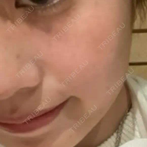 ピコレーザートーニング（美白・肝斑） 東京美容皮膚科アロエクリニック池袋 DAY 6 メイン用