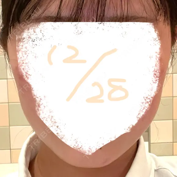 ボトックス（エラ・小顔） 東京美容皮膚科アロエクリニック池袋 DAY 1 メイン用