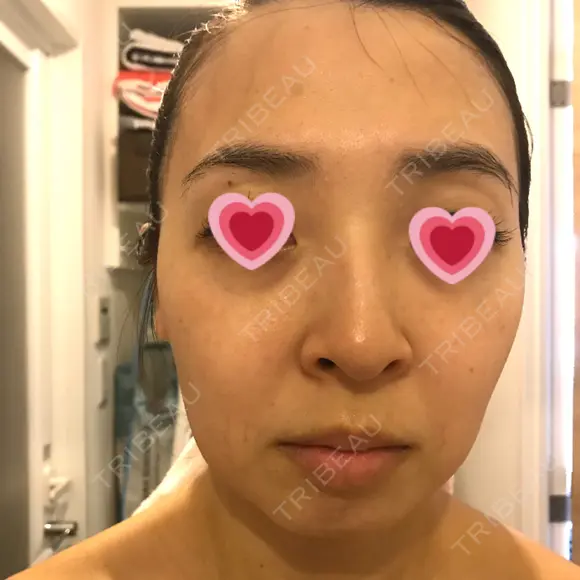 水光注射（ハリ・美肌） / ハイフ（顔） シロアム韓方美容・ダイエットクリニック(美&EYE) AFTER メイン用