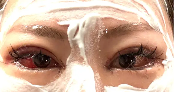 二重埋没 / 目頭切開 / 目尻切開 / タレ目形成・グラマラスライン（切開） / 目尻靭帯移動 BITO BEAUTY CLINIC DAY 2 メイン用