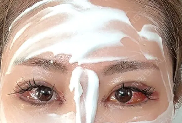 二重埋没 / 目頭切開 / 目尻切開 / タレ目形成・グラマラスライン（切開） / 目尻靭帯移動 BITO BEAUTY CLINIC DAY 3 メイン用