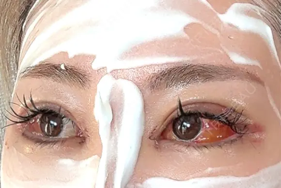 二重埋没 / 目頭切開 / 目尻切開 / タレ目形成・グラマラスライン（切開） / 目尻靭帯移動 BITO BEAUTY CLINIC DAY 3 メイン用