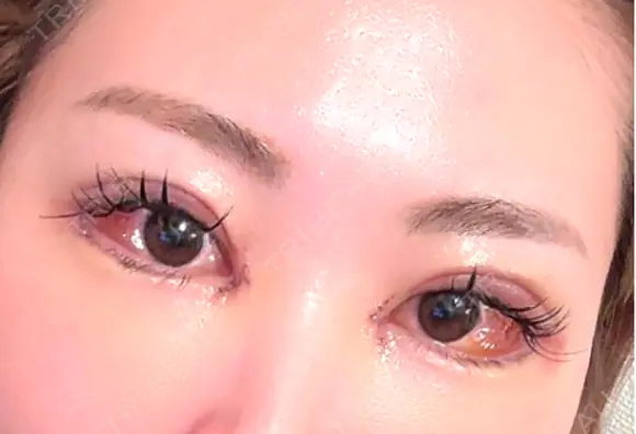 二重埋没 / 目頭切開 / 目尻切開 / タレ目形成・グラマラスライン（切開） / 目尻靭帯移動 BITO BEAUTY CLINIC DAY 4 メイン用