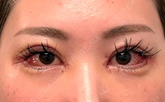 二重埋没 / 目頭切開 / 目尻切開 / タレ目形成・グラマラスライン（切開） / 目尻靭帯移動 BITO BEAUTY CLINIC DAY 6 メイン用
