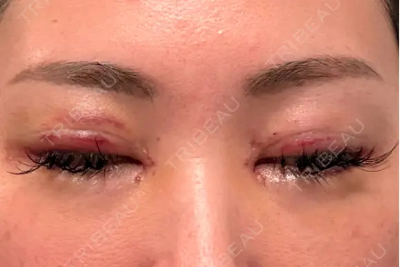 二重埋没 / 目頭切開 / 目尻切開 / タレ目形成・グラマラスライン（切開） / 目尻靭帯移動 BITO BEAUTY CLINIC DAY 6 メイン用