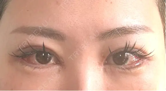 二重埋没 / 目頭切開 / 目尻切開 / タレ目形成・グラマラスライン（切開） / 目尻靭帯移動 BITO BEAUTY CLINIC AFTER メイン用